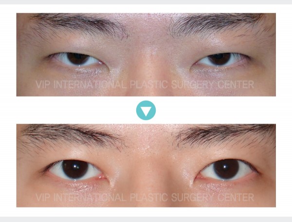 Eye Surgery - Блефаропластика у мужчин