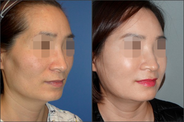 Stem Cell Fat Graft - Fat graft