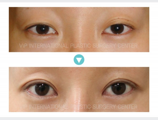 Eye Surgery - Коррекция птоза
