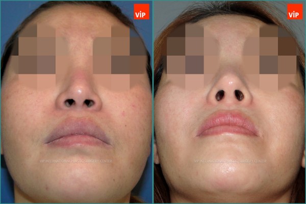 Nose Surgery - Ринопластика с использованием реберного хряща до и после
