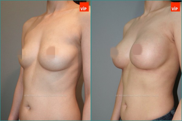Breast Surgery - Увеличение груди до и после