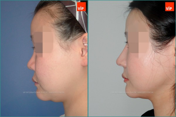 Nose Surgery - Ринопластика с использованием реберного хряща до и после