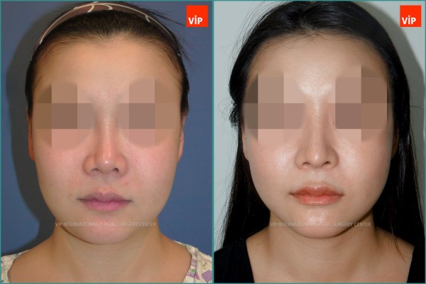 Nose Surgery - Ринопластика с использованием реберного хряща до и после