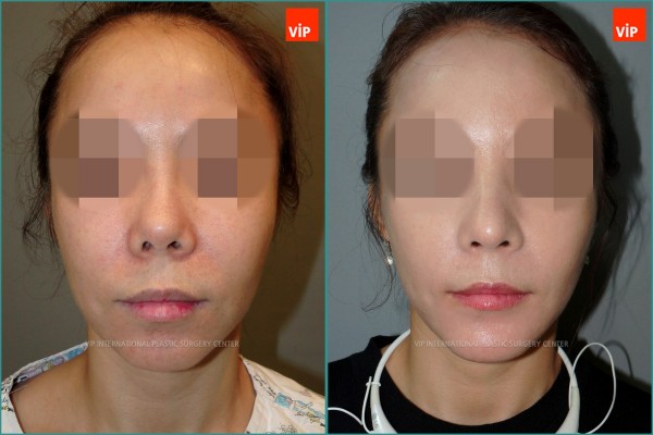 Nose Surgery - Ринопластика с использованием реберного хряща