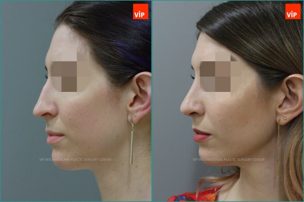 Nose Surgery - Ринопластика - ринопластика с коррекцией носовой перегородки