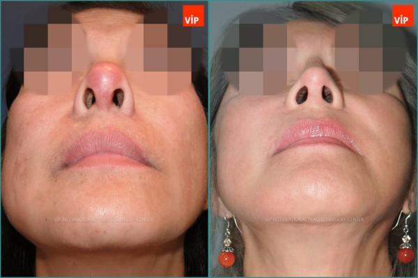 Nose Surgery - Ринопластика/ Подтяжка лица/ Повторная ринопластика / Ринопластика с использованием реберного хряща