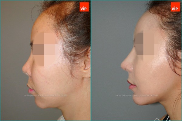 Nose Surgery - Ринопластика с использованием реберного хряща