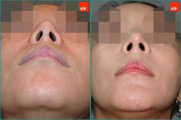 Nose Surgery - Ринопластика с использованием реберного хряща