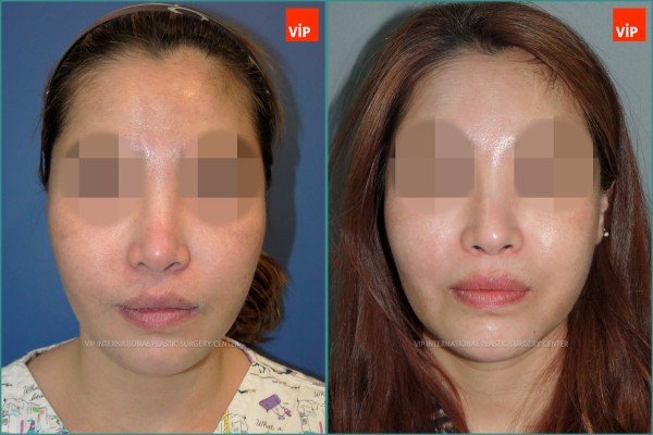 Nose Surgery - Ринопластика с использованием реберного хряща до и после