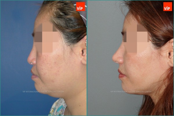 Nose Surgery - Ринопластика с использованием реберного хряща до и после