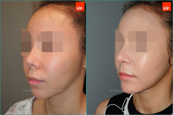 Nose Surgery - Ринопластика с использованием реберного хряща