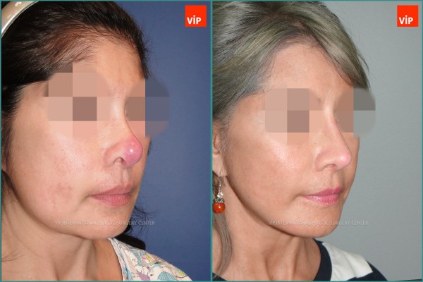 Nose Surgery - Ринопластика/ Подтяжка лица/ Повторная ринопластика / Ринопластика с использованием реберного хряща