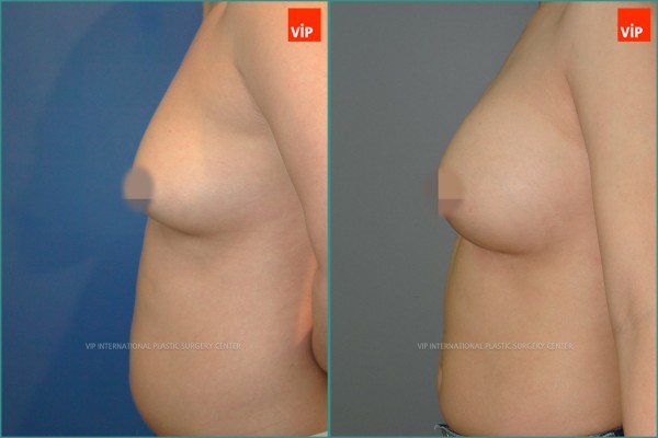Breast Surgery - Увеличение груди до и после
