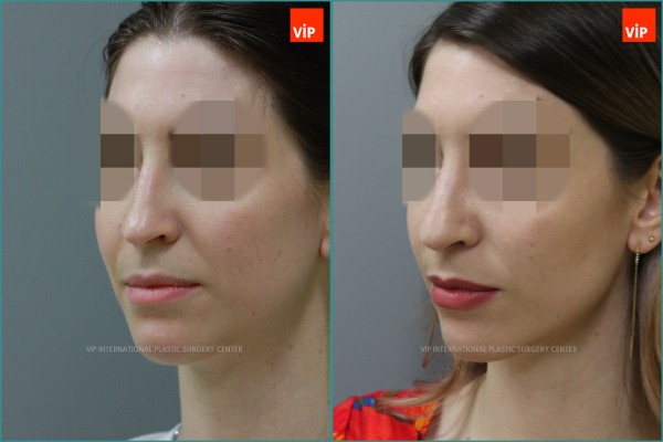 Nose Surgery - Ринопластика - ринопластика с коррекцией носовой перегородки