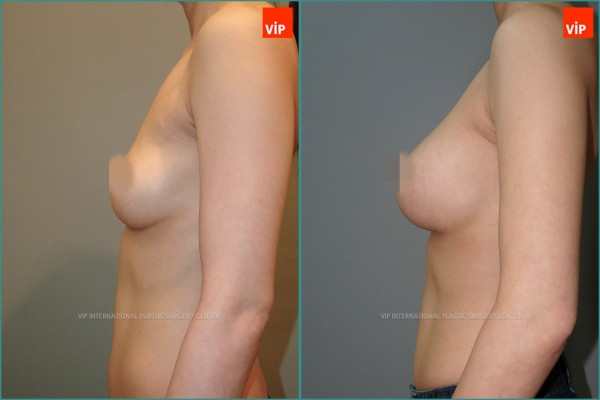 Breast Surgery - Увеличение груди до и после