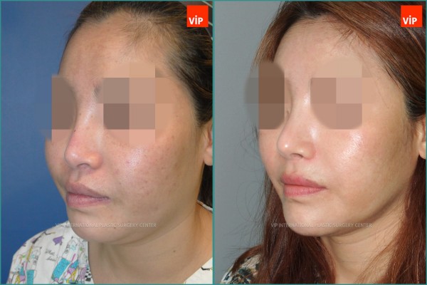 Nose Surgery - Ринопластика с использованием реберного хряща до и после