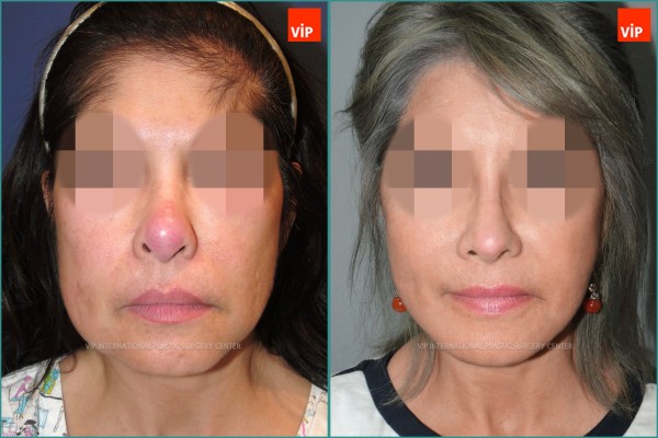 Nose Surgery - Ринопластика/ Подтяжка лица/ Повторная ринопластика / Ринопластика с использованием реберного хряща