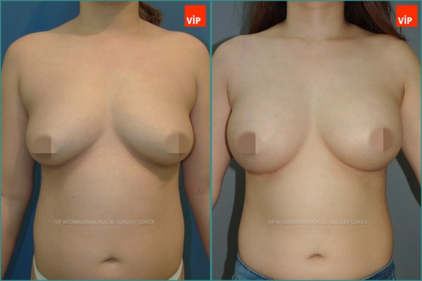 Breast Surgery - Увеличение груди до и после
