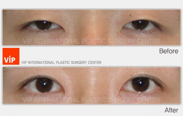 Eye Surgery - Создание &#034;двойного века&#034; (сангапури, сангопуль)