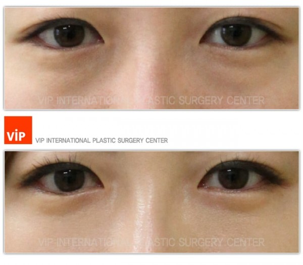 Eye Surgery - Перемещением тканей жира на нижнем веке - удалением мешком под глазами