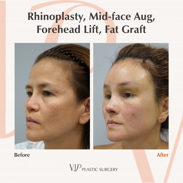 Nose Surgery, Face Lift, Stem Cell Fat Graft - Rhinoplasty, Fat graft, Forehead lift