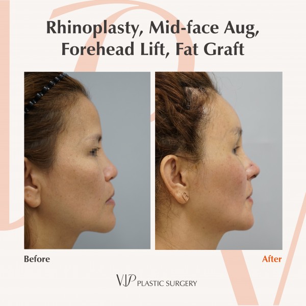 Nose Surgery, Face Lift, Stem Cell Fat Graft - Rhinoplasty, Fat graft, Forehead lift