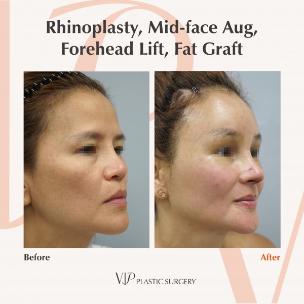 Nose Surgery, Face Lift, Stem Cell Fat Graft - Rhinoplasty, Fat graft, Forehead lift