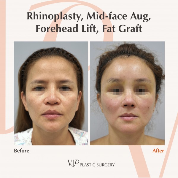 Nose Surgery, Face Lift, Stem Cell Fat Graft - Rhinoplasty, Fat graft, Forehead lift