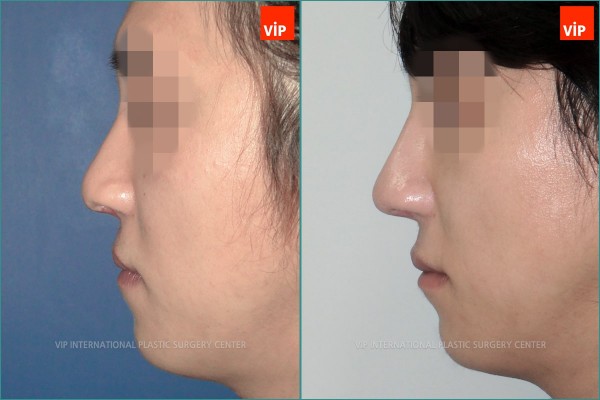 	Nose Surgery, Each Cases Nose	 - cleft lip nose surgery